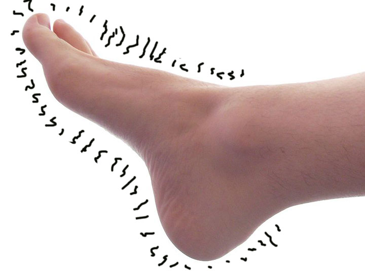 neuropathic_foot